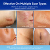 Aroamas Scar Silicone Scar Tape