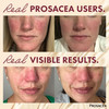 Prosacea - Medicated Rosacea Treatment for Face