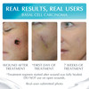 Advanced High-Potency Silicone Scar Gel with Vitamin E for Old, New Scars