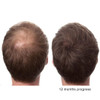 The Original Pure Natural X2 Action BIOTIN DHT Blocker BETA SITOSTEROL FL