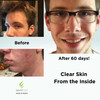 Clear Skin Acne Vitamin System - 20 Antioxidants, Botanicals & Minerals