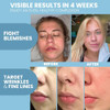 Retinol Serum for Face with Hyaluronic Acid Anti Aging Skin Care for Fine Lines Wrinkles Dark Spots Blemish Brightening