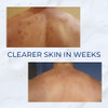 Body Acne Treatment Scrub Helps Reduce Body Breakouts on Back Chest Shoulders and Thighs Back Acne Treatment for Men Wom