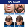 Kirkland Signature Minoxidil for Men 5 Extra Strength Hair Regrowth for Men vqzjBI 1 Month Supply