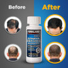 Minoxidil5 Extra Strength Hair Regrowth for Men 6 Month Supply