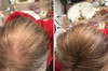 Caboki Hair Loss Concealer Makes Thin Hair Look 10X Fuller Instantly Eliminates Bald Spot and Thinning Hair 30G 90Day Su