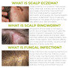 Folliculitis Shampoo Antifungal Shampoo for Seborrheic Dermatitis Scalp Psoriasis Dandruff Soothes Itchy Dry Scalp Clean