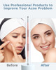 TAYTHI Blackhead Remover Tool Pimple Popper Tool Kit Blackhead Extractor Tool for Face Extractor Tool for Comedone Zit A