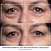 Wrinkles Schminkles Under Eye Wrinkle Patches Smooth Eye Wrinkles Crows Feet Dark Circles Overnight 6 Pairs Reusable Med