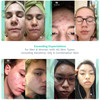 Purifying Toner for Face Skin Pore Minimizer Facial Astringent Acne Treatment for Women Men Witch Hazel Lavender Sage Ho