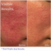 Hey Honey Skincare Relax Instant Rosacea Relief Cream for Sensitive Skin Calming Face Moisturizer for Facial Redness Irr