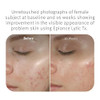 Epionce Lytic Tx Product for Combination to Oily Problem Skin with Salicylic Acid Hyaluronic Acid Azelaic Acid Dermatolo