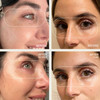 Dermaclara Silicone Patch Eyes Forehead Kit AntiWrinkle Face Patches for Frown Smile Lines Reusable Overnight Silicone W