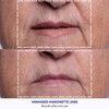 Wrinkles Schminkles Facial Smoothing Set Mouth Lip 2Pack Eye Wrinkle Patches 3Pairs Forehead Wrinkle Patches 2Pack Reusa