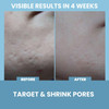 Niacinamide 5 Serum for Face B3 Pore Minimizer Acne Treatment Dark Spot Corrector with Hyaluronic Acid Vitamin E Aloe Ne