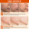 Acne Cream Pimple Cream for Face Oil Control Pimple Remover Cream Get Rid of Pimples Fastfor Oily and Acne Prone Skin Cr