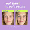 Dermalogica Clear Start PostBreakout Fix Acne Dark Spot Treatment with Salicylic Acid Squalene Hexylresorcinol Fade Brig