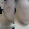 BONAJOUR Extreme Acne Blemish Spot Repair Remove Serum The Best Acne Blemish Clear Repair Brightening Remove Acne Serum