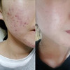 BONAJOUR Extreme Acne Blemish Spot Repair Remove Serum The Best Acne Blemish Clear Repair Brightening Remove Acne Serum