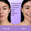 NXN Acne Edit Spot Treatment with Probiotics Licorice Root Ginger and Colloidal Sulfur to rapidly reduce acne blemish si