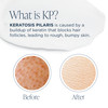 Glytone KP Kit Exfoliating Body Wash Glycolic Acid Lotion Shower Pouf for Keratosis Pilaris Smooth Rough Bumpy Skin Frag