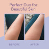 KP Bump Eraser Body Scrub Keratosis Pilaris Lotion Bundle Set Strawberry Legs Treatment for Women Exfoliates Deeply Hydr