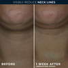RoC Derm Correxion Neck Cream with Hyaluronic Acid Advanced Retinol to visibly Tighten Lift Horizontal Neck Lines Facial