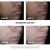 Neutrogena Stubborn Acne AM Face Treatment with 25 Micronized Benzoyl Peroxide Acne Medication OilFree Daily Facial Trea