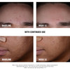 Neutrogena Stubborn Blackheads Daily Acne Facial Serum with Salicylic Glycolic Polyhydroxy Mandelic Acids OilFree Face S