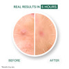 YOUR Improving Acne Patches Ultrathin Hydrocolloid Healing Pimple Patch for Face Purifies Alleviates Stubborn Blemishes