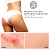AntiAcne Buttocks Thigh Treatment Clears Away Acne Pimples Zits Dark Spots Ingrown Hairs on the Buttocks Thigh Area Prev