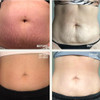 Dermaclara Silicone Patch Stretch Mark Kit Pregnancy Stretch Mark Prevention C Section Cover Up Belly Scar Maternity Ski