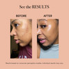 reVive Light Therapy Lux Collection Spot Acne Device Portable Red Blue Light LED Therapy Products for BlemishProne Skin