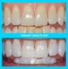 Vibe Teeth Whitening Pens Healthy Peroxide Free 4 Pack NonToxic Fast Results 3ml per pen Vegan Painless teeth whitening