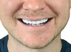 Instant Smile Flex 2pk Bright White Shade One Size Fits Most Fix Your Smile at Home in Minutes Comfortable Upper Cosmeti