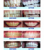 Crystal Clear Teeth Whitening Kit 35 Carbamide Peroxide Teeth Whitening Gel with Rechargeable LED Light Dentists Recomme