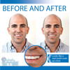 Instant Smile Temporary Tooth Kit ProSeries