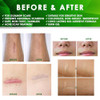 Tobcharm Advanced Keloid Bump Removal: Silicone Keloid Scar Removal Cream for Scars from Piercing, Surgical Marks,