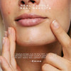 Vue Chin Patches  Hydrocolloid Pore Patches for Chin and Jawline Breakouts, Pimples, Oil Control and Texture