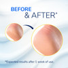 Dr. Scholl's Severe Cracked Heel Repair Restoring Balm 2.5oz, with 25% Urea for Dry, Cracked Feet, Heals and