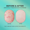 Butt Acne Cream | Buttocks Acne Lotion for Body Blemishes | Body Acne Cream Formulated with Natural Formula | Butt