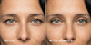 Contours Rx Lids By Design N Degree 7 Instant Eyelid Lift Strips For Dramatic Lift On Hooded Droopy Eyelids Medical Grade Anti Aging Non