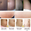 Rtopr Mango Stretch Marks And Scar Cream Stretch Marks And Scar Removal Cream For Pregnancy Best Body Moisturizer 40G