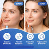 Cleari Pimple Patches 72 Patches Dermatologist Tested Invisible 2Mm Covers For All Skin Types Pore Cleansing Day And Night 2 Sizes Acne