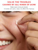 Essentya Cosmetics Pimple Patches For Acne 72 Units Invisible Hydrocolloid Patches For Day And Night.