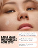 Peace Out Early Stage Acne Microneedling Hydrocolloid Dots 8 Count