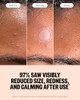 Peace Out Early Stage Acne Microneedling Hydrocolloid Dots 8 Count