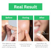 Mega Patch Hydrocolloid Pimple Patches For Face 36Ct Invisible 8Mm And 12Mm Acne Patches For Zits Pimples And Blemishes Vegan And Cruelty