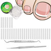 30 Plus 2 Pack Ingrown Toenail Correction Treatment Kit 30Pcs Ingrown Toenails Corrector Strips Brace Ingrown Toenail Pedicure Tool Toenail