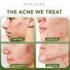 Exposed Skin Care, Expanded Acne Treatment Kit with 2.5% Salicylic Acid and 3.5% Benzoyl Peroxide to Clear Up Teen, Adult, Hormonal and Cystic Acne 